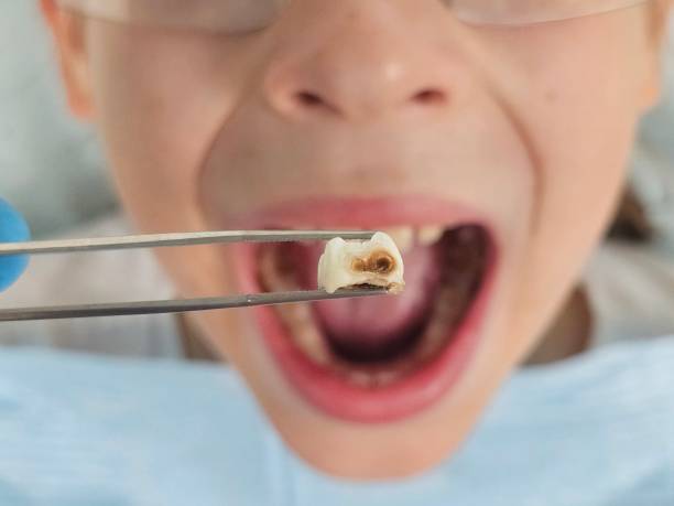 Best Emergency Treatment for Dental Infections or Abscesses in Bridgeville, PA